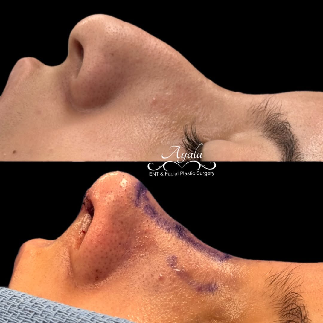 Instagram post by Dr. Carlos Ayala: Intraoperative Before & After ✨ A closer look at the transformation during rhinoplasty—refining the nasal structure while preserving balance…