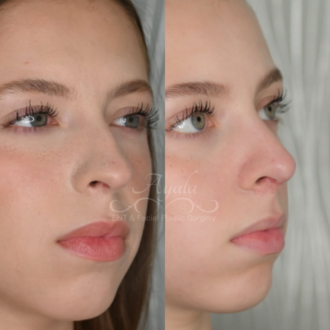 Instagram post by Dr. Carlos Ayala: A beautiful 3-week rhinoplasty result 🤍 Remember: the nose is still healing, and refinement continues over time. Swipe ➡️ Which view is you…