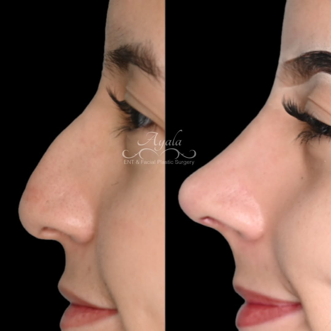 Instagram post by Dr. Carlos Ayala: ✨ 3 Weeks Post-Op Open Rhinoplasty ✨ A beautiful early look at her transformation. At just 3 weeks, swelling is still present and the nose w…
