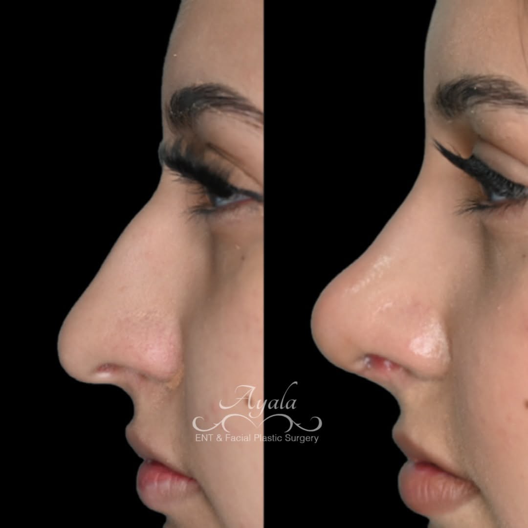 Instagram post by Dr. Carlos Ayala: ✨ 3 Weeks Post-Rhinoplasty ✨ A beautiful early look at this patient’s progress. At just 3 weeks, swelling is still present and the nose will…