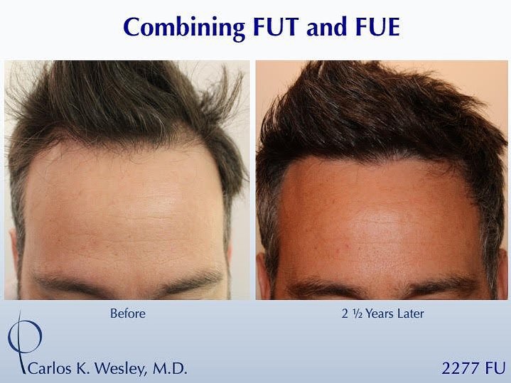 Instagram post by Dr. Carlos K. Wesley: #BeforeAndAfterMondays . . . . . To schedule an appointment with @drcarloswesley: Link in the bio. Let us know if you found us on Instagram!…