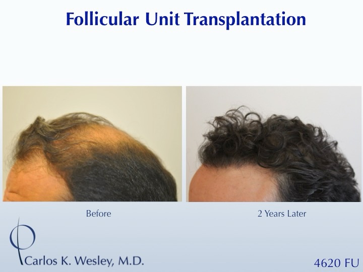 Instagram post by Dr. Carlos K. Wesley: #BeforeAndAfterMondays #BAM . . . . . To schedule an appointment with @drcarloswesley: Link in the bio. Let us know if you found us on Insta…
