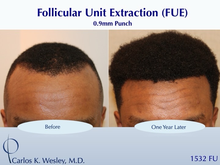 Instagram post by Dr. Carlos K. Wesley: #BeforeAndAfterMondays #BAM . . . . . To schedule an appointment with @drcarloswesley: Link in the bio. Let us know if you found us on Insta…