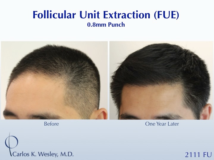 Instagram post by Dr. Carlos K. Wesley: #BeforeAndAfterMondays #BAM . . . . . To schedule an appointment with @drcarloswesley: Link in the bio. Let us know if you found us on Insta…