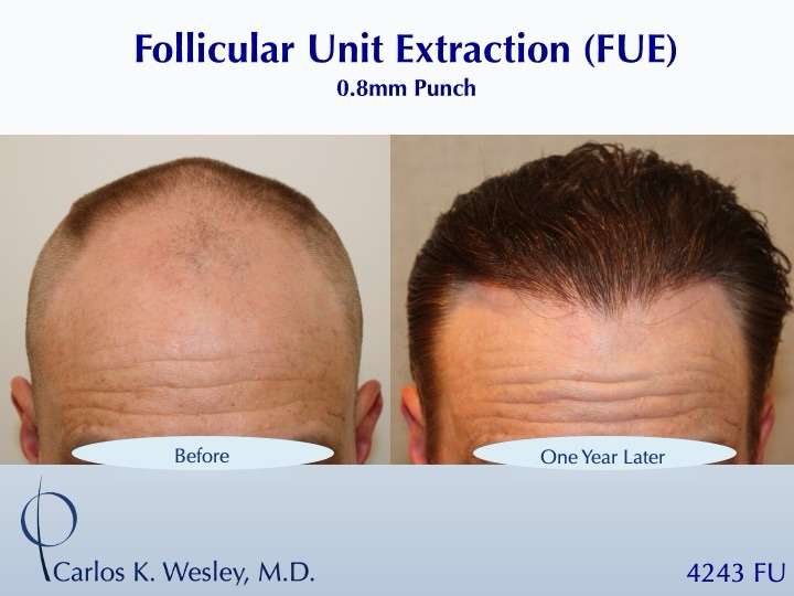 Instagram post by Dr. Carlos K. Wesley: #BeforeAndAfterMondays #BAM . . . . . To schedule an appointment with @drcarloswesley: Link in the bio. Let us know if you found us on Insta…