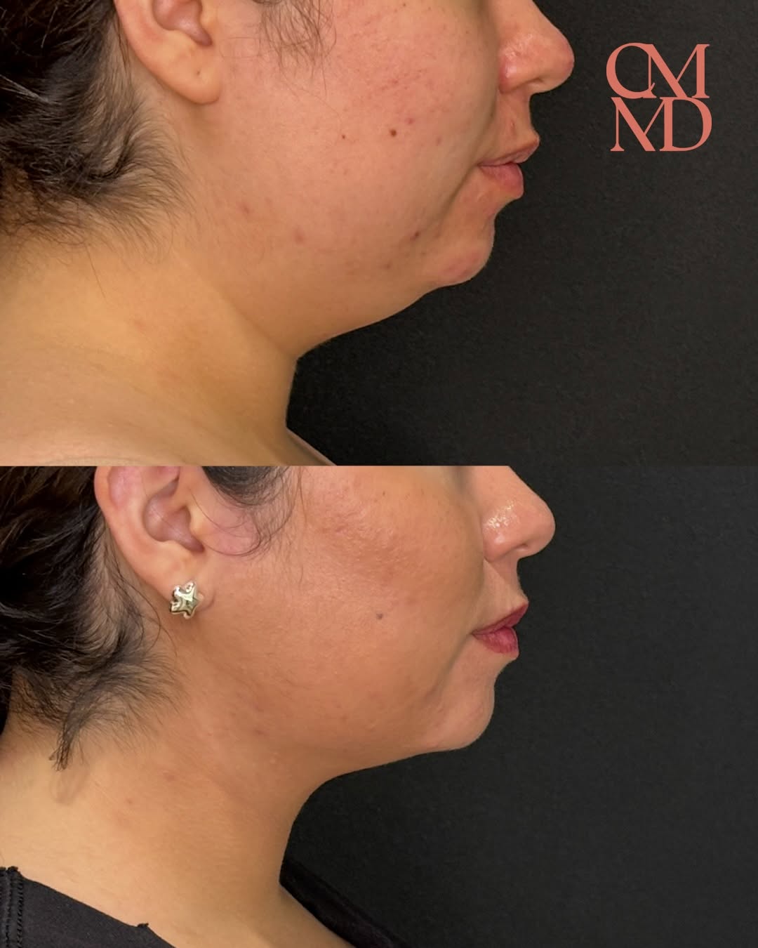 Instagram post by Dr. Caroline Min: ✨ A subtle change that makes a BIG difference. This chin liposuction before & after shows how removing stubborn fat beneath the chin can cre…