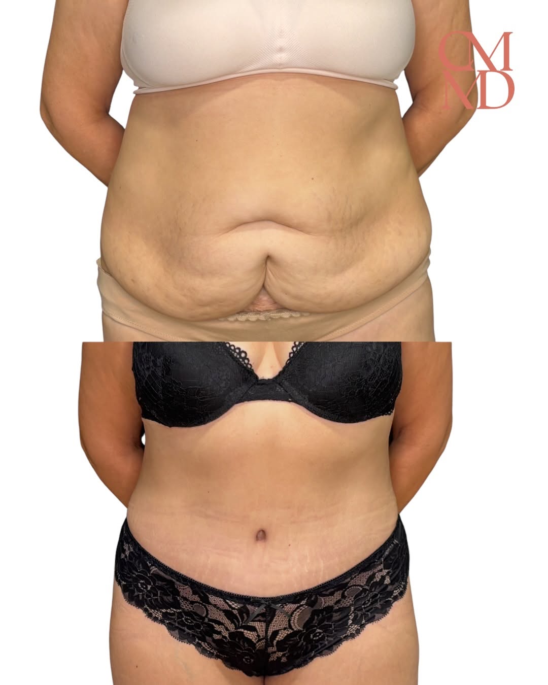 Instagram post by Dr. Caroline Min: ✨ Tummy Tuck Before & After ✨ For this patient, loose abdominal skin after pregnancy and a previous abdominal scar left her feeling self-con…