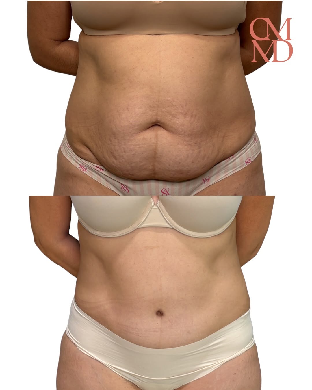 Instagram post by Dr. Caroline Min: ✨ Tummy Tuck Before & After ✨ After having 4 children, this mom wanted to address excess abdominal skin and restore the appearance of her mi…