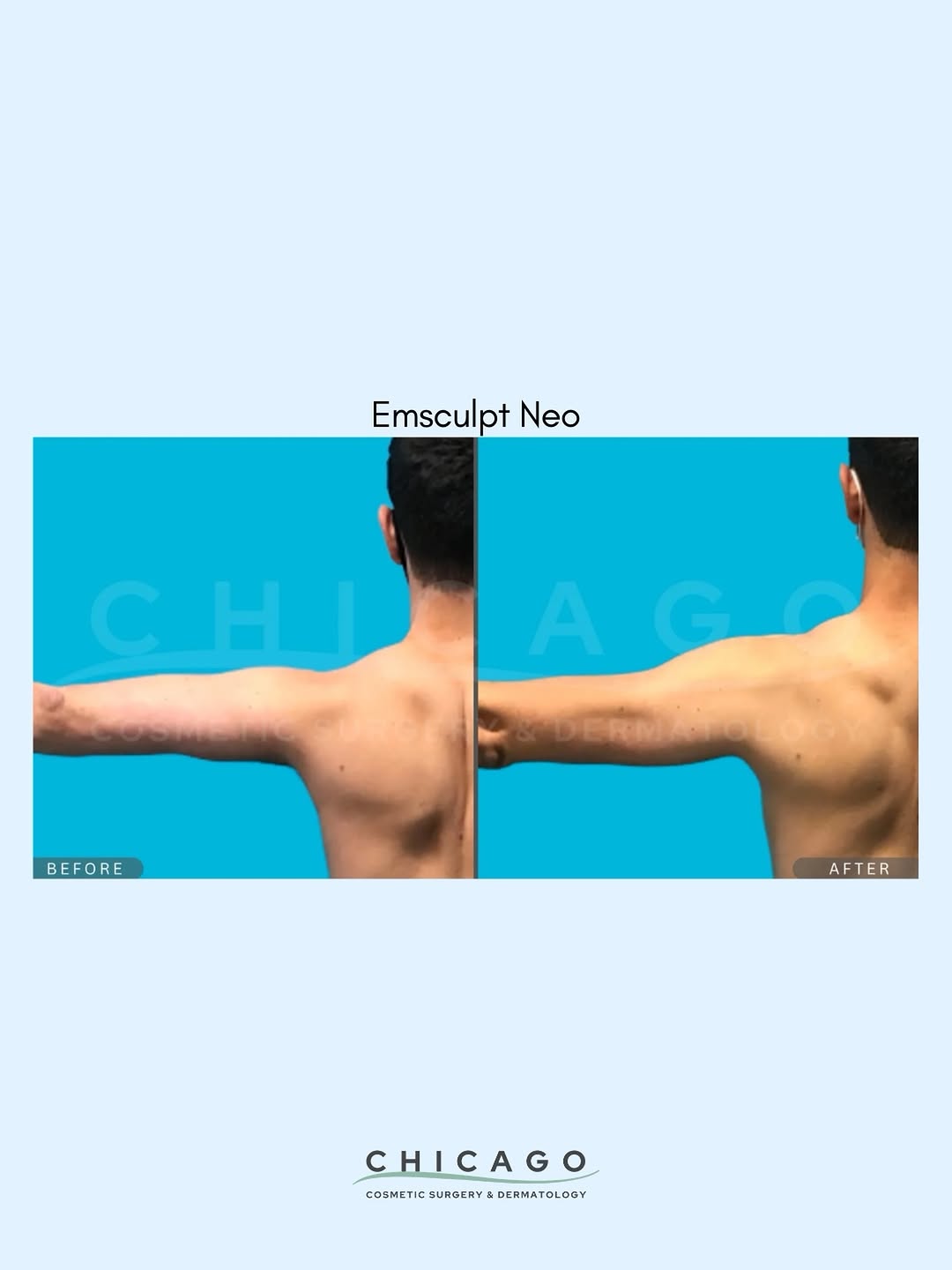 Instagram post by Dr. Carolyn Jacob: You’re doing the workouts… but that one area still isn’t giving what it should. 👀 That’s where EMSCULPT NEO® can come in. It combines muscl…
