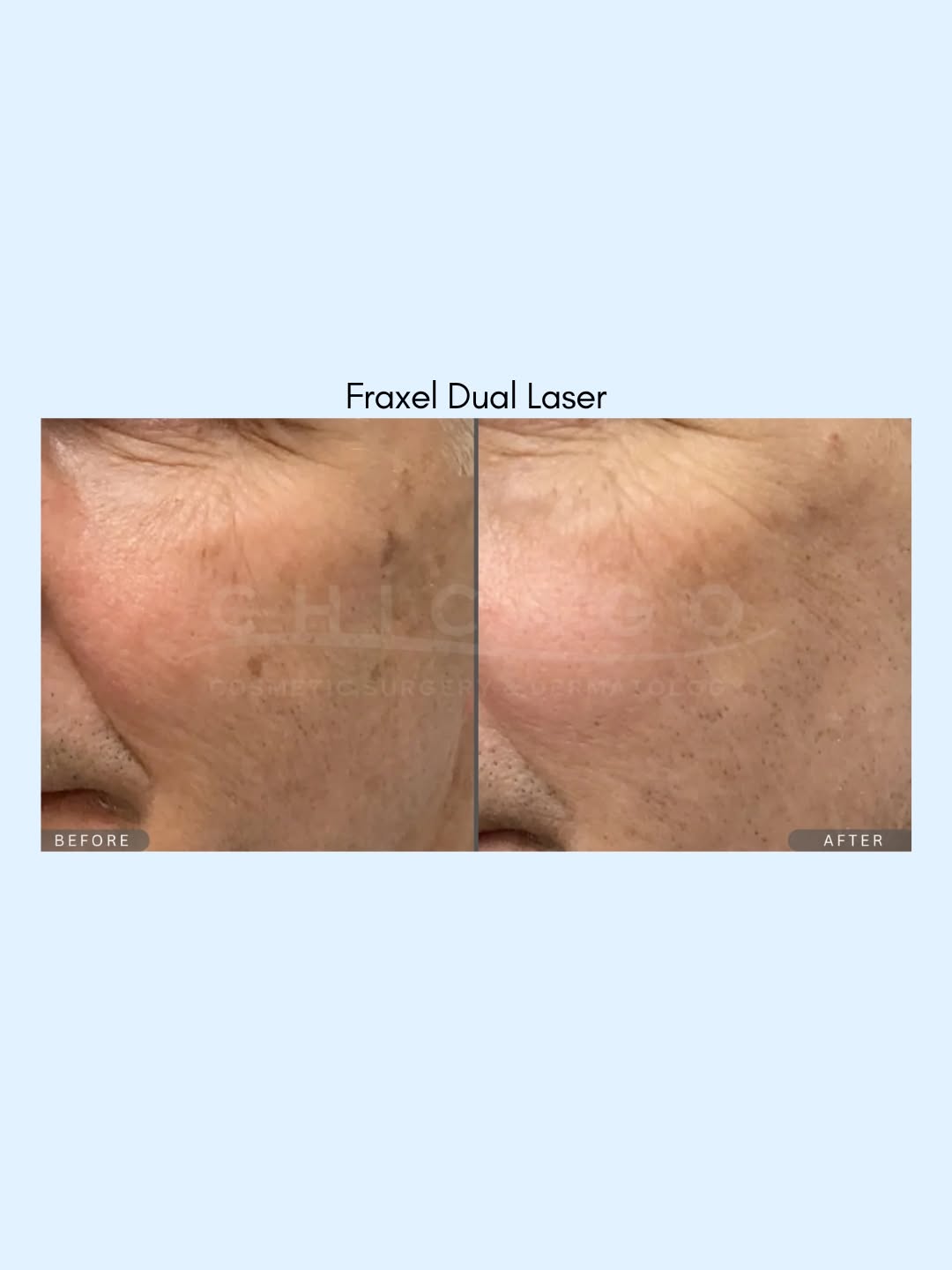 Instagram post by Dr. Carolyn Jacob: The Fraxel results speak for themselves! Less visible sun damage. More even-looking tone. Smoother, refreshed skin. Fraxel® DUAL is coming t…