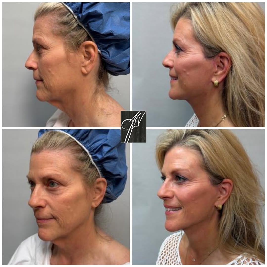 Instagram post by Dr. Carrie Houssock: 3 months out from #deepplane lower face and neck lift with full face CO2 laser ❤️ #deepplanefacelift #co2 #CO2laser