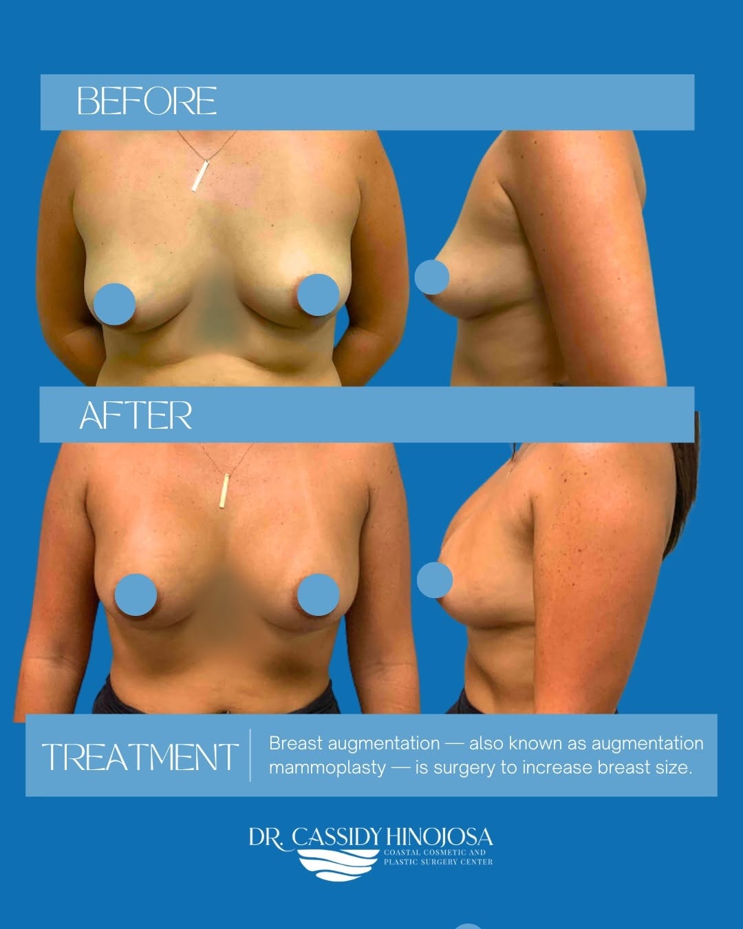Instagram post by Dr. Cassidy Hinojosa: Confidence is in bloom! The transformative power of breast augmentation surgery is truly miraculous. From embracing her personal goals to ac…