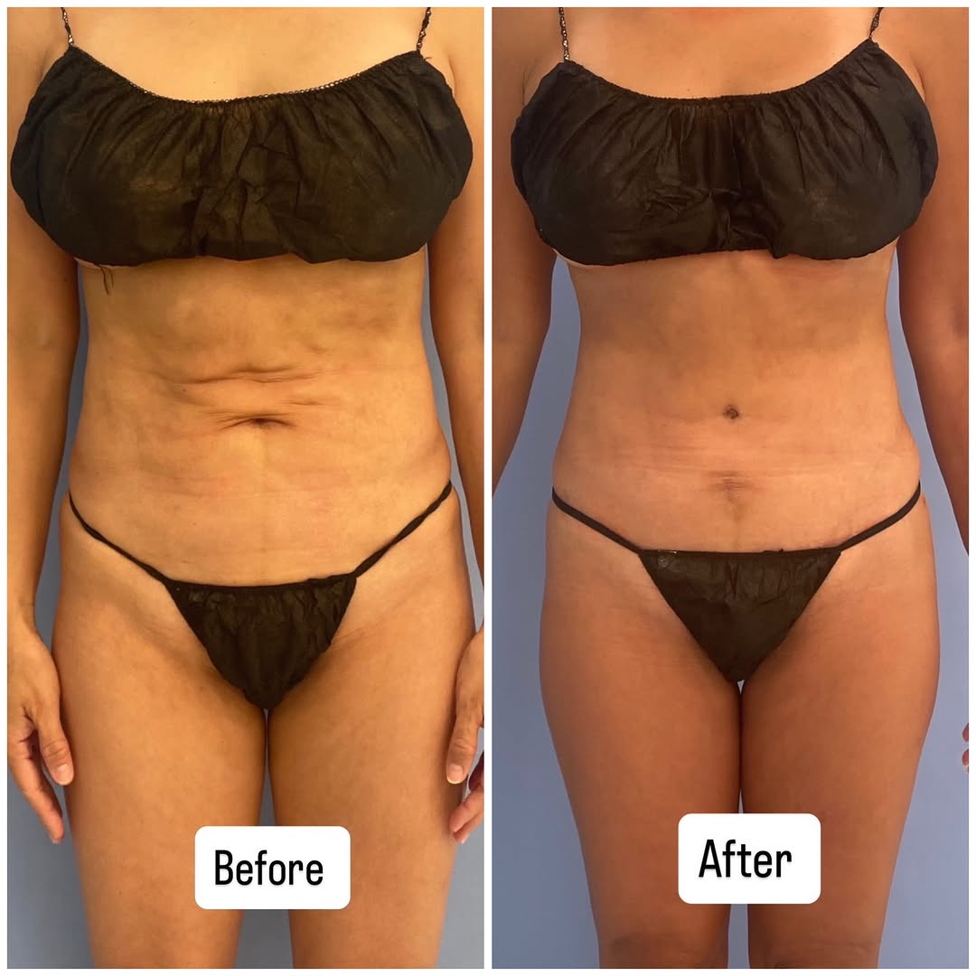 Instagram post by Dr. Catherine Huang-Begovic: This month, almost every surgery I am doing is a revision - liposuction revision, breast revision, tummy tuck revision, labiaplasty revision…