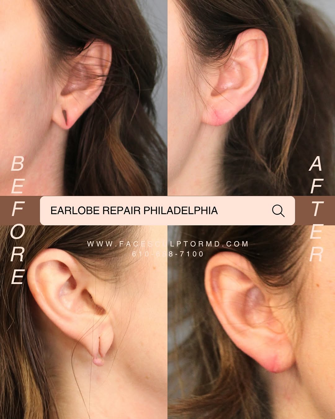 Instagram post by Dr. Catherine Weng: When you have grown out of your gages,I’ll be here for you to make it look like you never had them in the first place. Ear lobe repair is a …