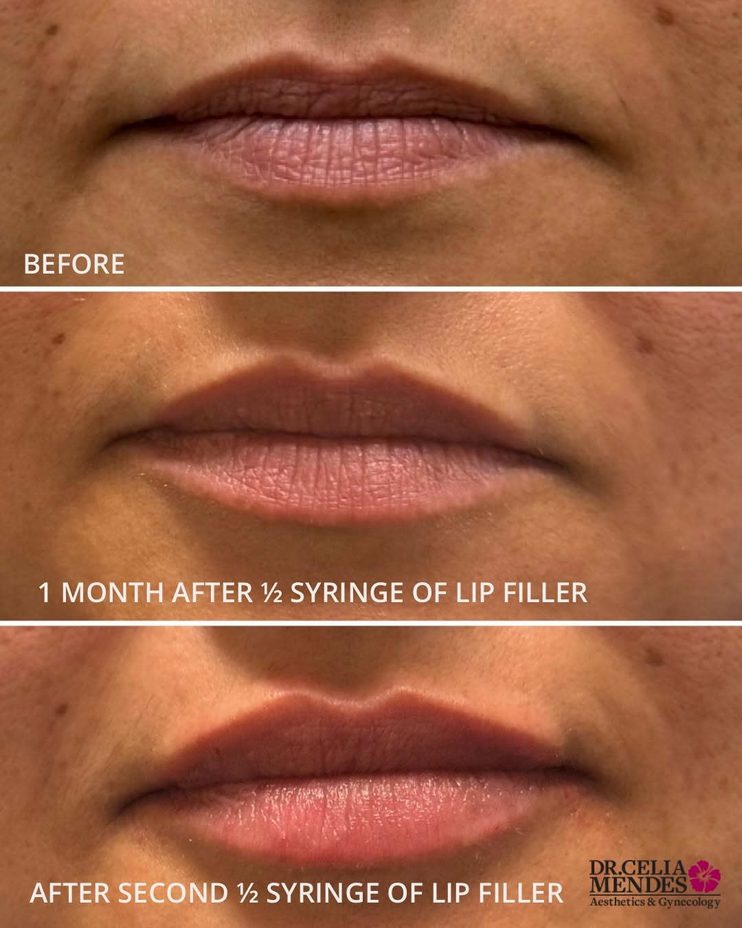 Instagram post by Dr. Celia Mendes: ✨ Subtle, buildable, and beautifully balanced. ✨ This transformation shows what can happen when you take a gradual approach to lip filler. �…