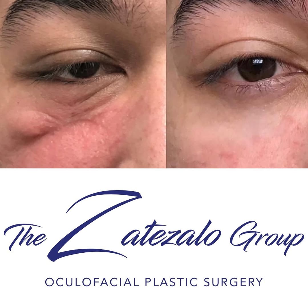 Instagram post by Dr. Chad C. Zatezalo: Scar treatment tools that lead to real results 🤩 The Zatezalo Group offers customized scar treatment plans for each patient. Injectables, s…
