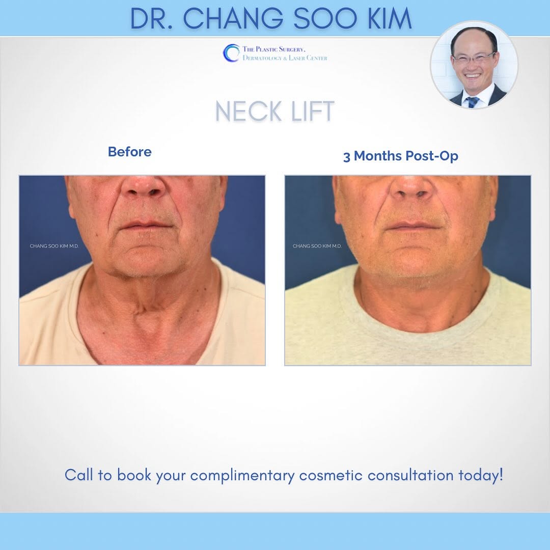 Instagram post by Dr. Chang Soo Kim: Say goodbye to the “turkey neck”! 🦃✨ Call 203-920-1444 A neck lift restores a smooth, defined jawline by tightening loose skin, removing ex…