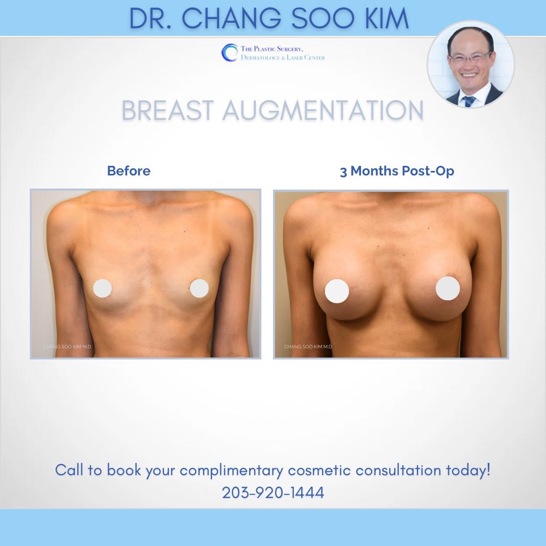 Instagram post by Dr. Chang Soo Kim: You deserve to feel confident in your own skin 🤍 This patient is 3 months post-op from breast augmentation, with results designed to look b…