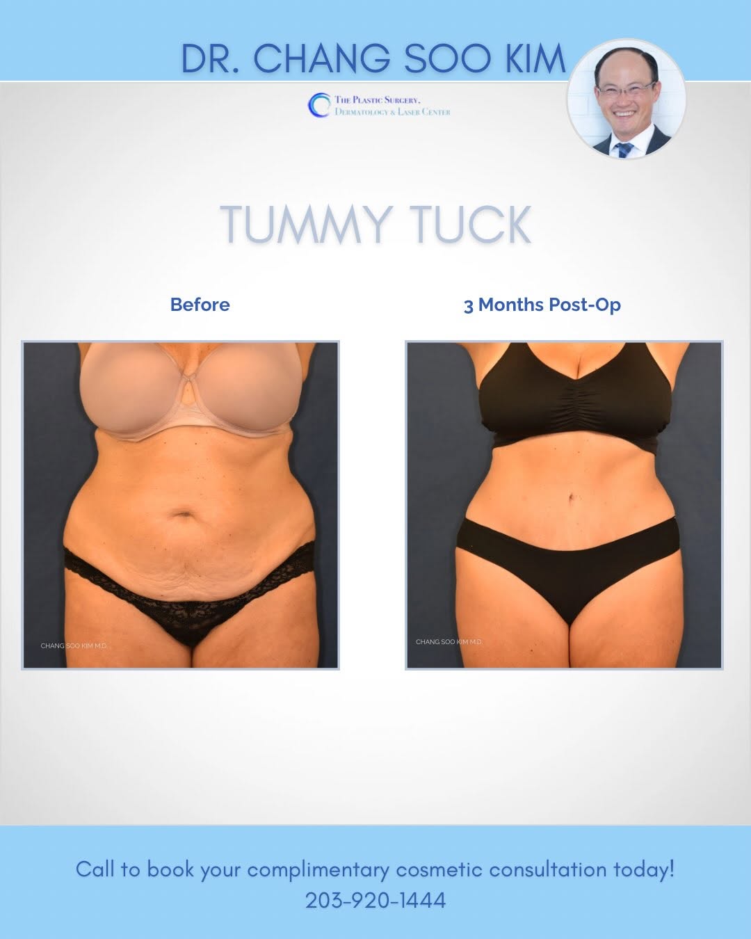 Instagram post by Dr. Chang Soo Kim: Respectfully… can we talk about that waist? 👀 This tummy tuck result is just 3 months post-op and she’s already looking incredible. If you’…