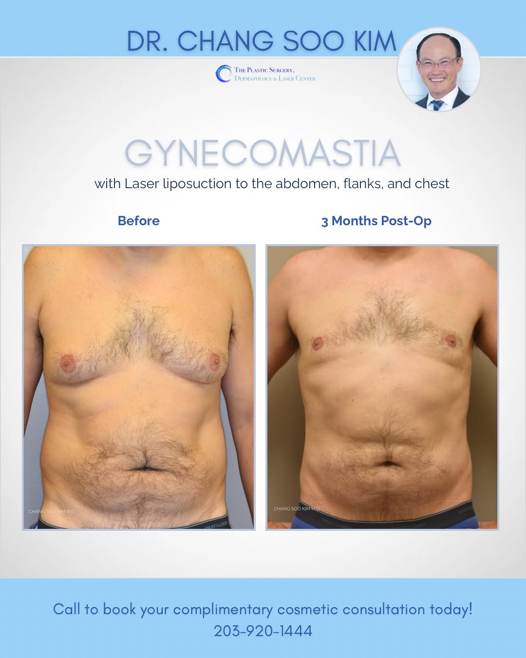 Instagram post by Dr. Chang Soo Kim: Men, we know you’re lurking too. 👀 You can hit the gym, lose the weight, do all the chest days you want, but if gynecomastia is the issue, …