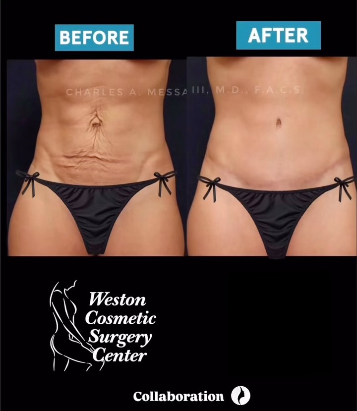 Instagram post by Dr. Charles A. Messa III: 🚨 SHARE THIS WITH SOMEONE CONSIDERING A TUMMY TUCK! 🚨 And follow @drcharlesmessa for more real plastic surgery results. 👨⚕️ A TUMMY TUCK…