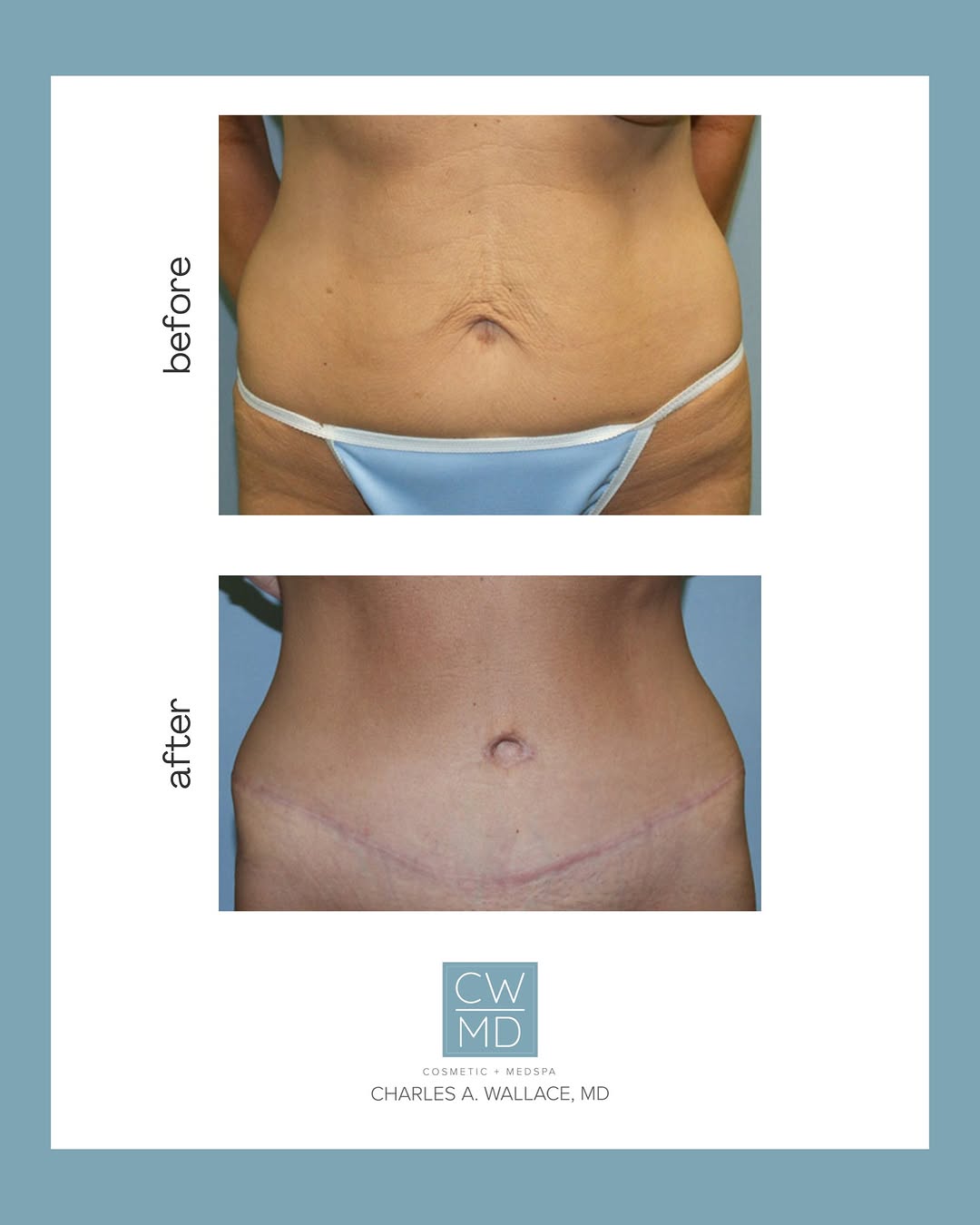 Instagram post by Dr. Charles A. Wallace: Take a look at this stunning tummy tuck done by Dr. Wallace! From the flatter, more contoured midsection to the renewed confidence of the pa…
