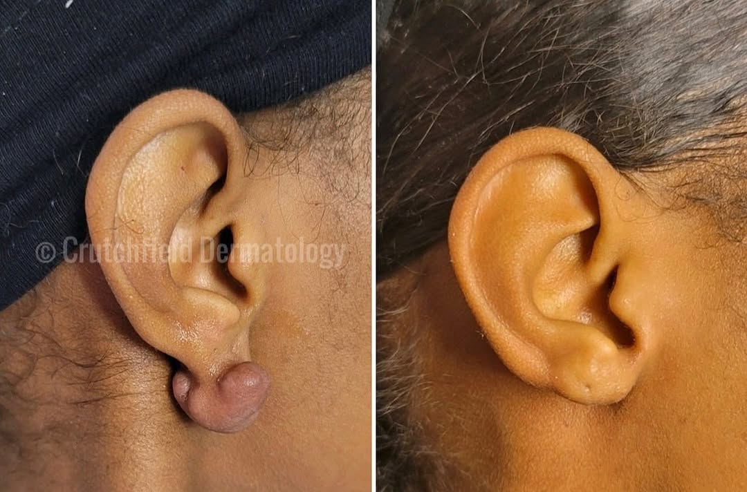 Instagram post by Dr. Charles E. Crutchfield III: Our latest keloid removal success #keloid #keloidremoval #keloids #keloidscar #keloidawareness #keloidscarremoval
