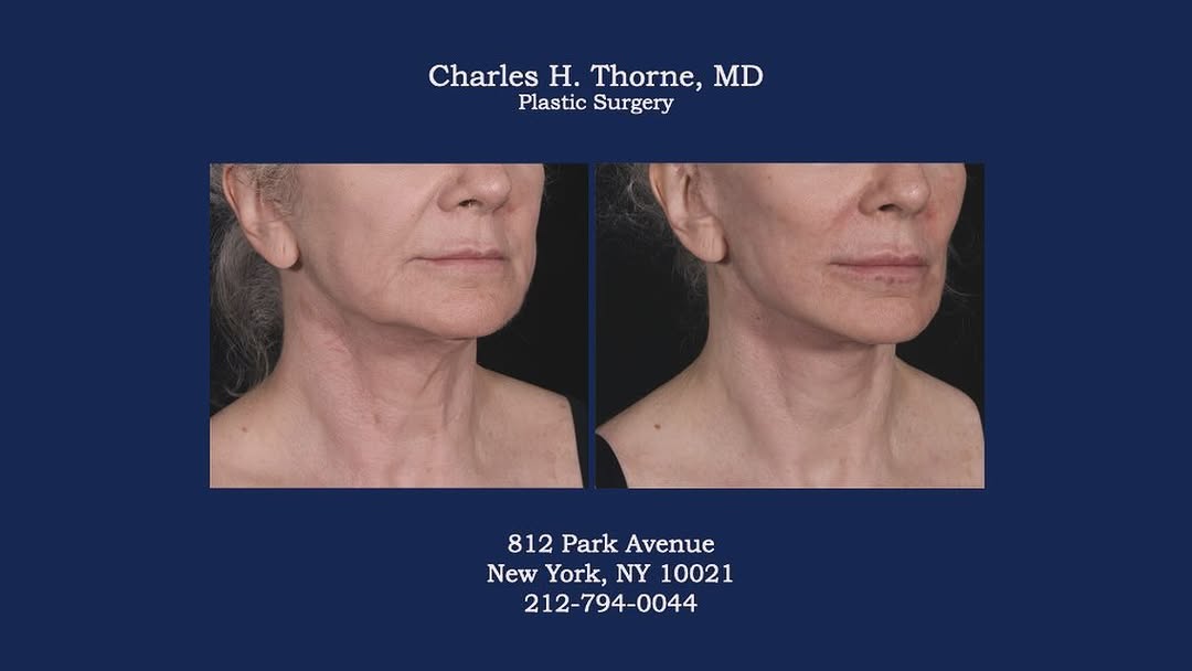 Instagram post by Dr. Charles H. Thorne: Before and after facelift/necklift by Dr. Thorne. . . . . . . . #necklift #facelift #charlesthornemd #naturallook #plasticsurgery #plasticsu…