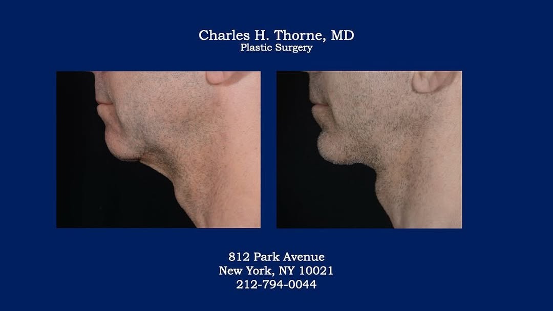 Instagram post by Dr. Charles H. Thorne: Before and after neck lift and chin implant exchange by Dr. Thorne. . . . . . #necklift #facelift #chinimplant #charlesthornemd #naturallook…