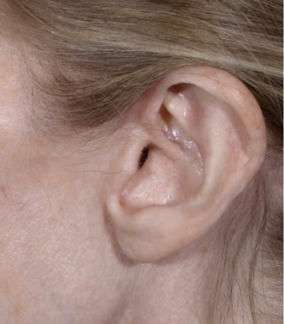 Instagram post by Dr. Charles H. Thorne: “Scarless” facelift. The patient is shown 6 months after facelift by Dr. Thorne. Note that the incisions are not visible and there is no dis…