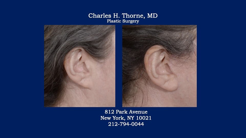 Instagram post by Dr. Charles H. Thorne: Before and after facelift with creation of an earlobe by Dr. Thorne . . . . . . #facelift #earlobes #charlesthornemd #naturallook #cosmetics…
