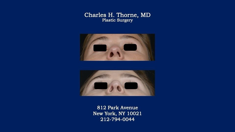 Instagram post by Dr. Charles H. Thorne: Before and after rhinoplasty by Dr. Thorne to narrow and straighten the nasal tip. . . . . . #rhinoplasty #nosejob #charlesthornemd #natural…