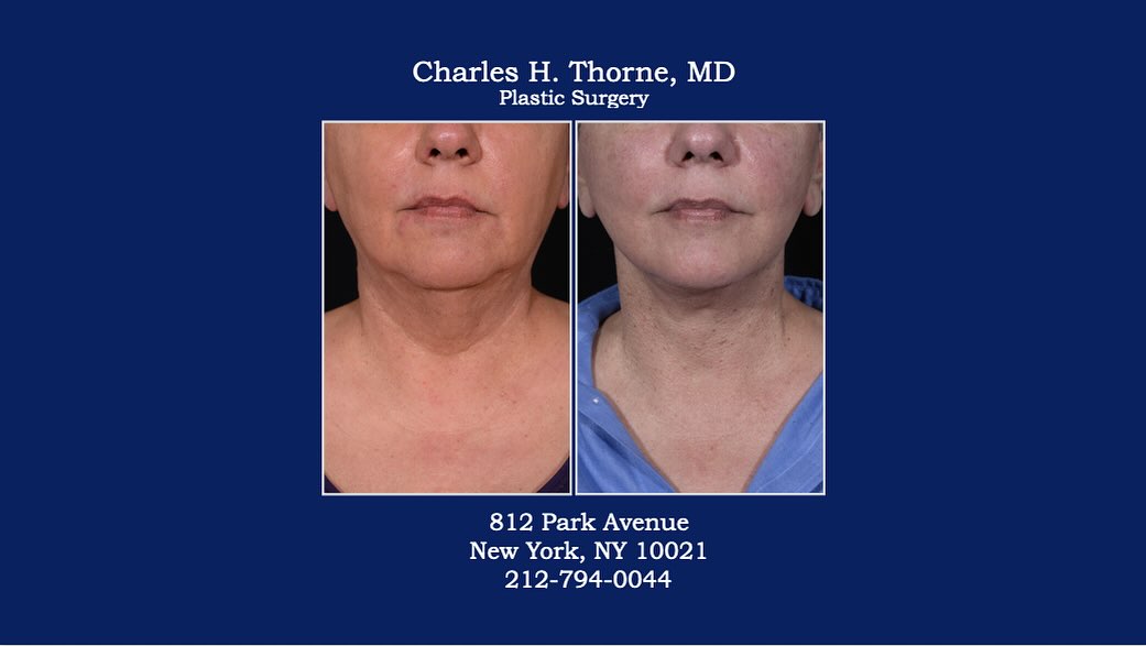 Instagram post by Dr. Charles H. Thorne: Before & after lower face and necklift by Dr. Thorne. . . . . . . . #facelift #faceliftbeforeandafter #necklift #neckliftbeforeandafter #pla…