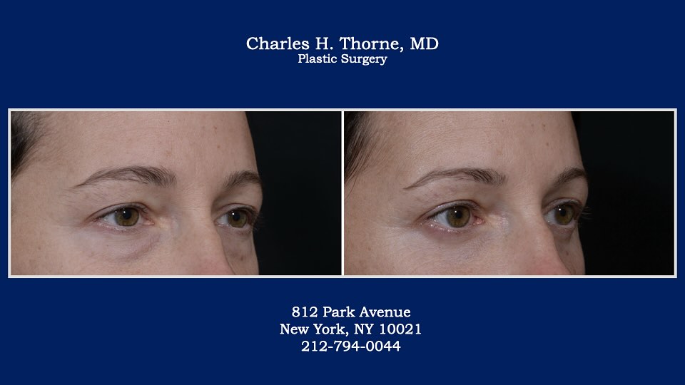 Instagram post by Dr. Charles H. Thorne: Before and after lower eyelid surgery by Dr. Thorne. . . . . . . . #blepharoplasty #lowerbleph #lowerblepharoplasty #plasticsurgeon#plastics…