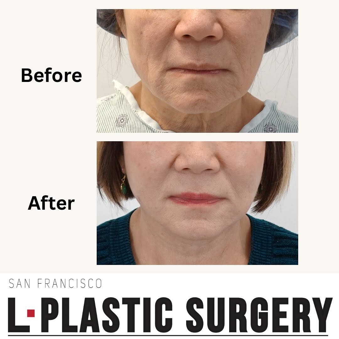 Instagram post by Dr. Charles K. Lee: This patient is 2 month post op SMAS facelift. “I am so happy I can wake up feeling beautiful. I feel 20 years younger!” We are so happy we …