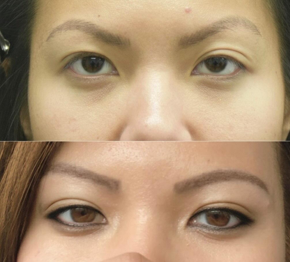 Instagram post by Dr. Chase Lay: This patient’s droopy eyelid was due to a stretched, thin levator tendon. The condition was expertly corrected by Dr. Chase Lay, MD, a speci…