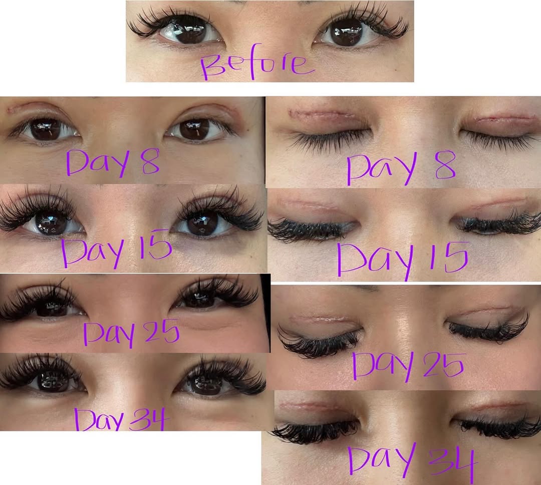 Instagram post by Dr. Chase Lay: The evolution of eyelids incisions is a process that is weeks and months long. Redness firmness, tenderness and bumps in the first few month…