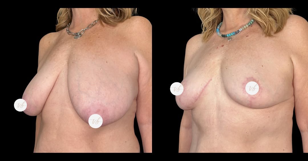 Instagram post by Dr. Chelsea Snider: #TRANSFORMATIONTUESDAY Lifted. Sculpted. Confident 🤍 For this patient, Dr. Snider combined a breast lift with targeted abdomen liposuction …