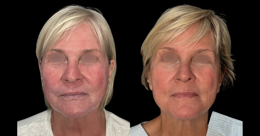 Instagram post by Dr. Chelsea Snider: #TRANSFORMATIONTUESDAY Have you ever struggled with rosacea or stubborn vascular redness that doesn't go away no matter what you do or use? …
