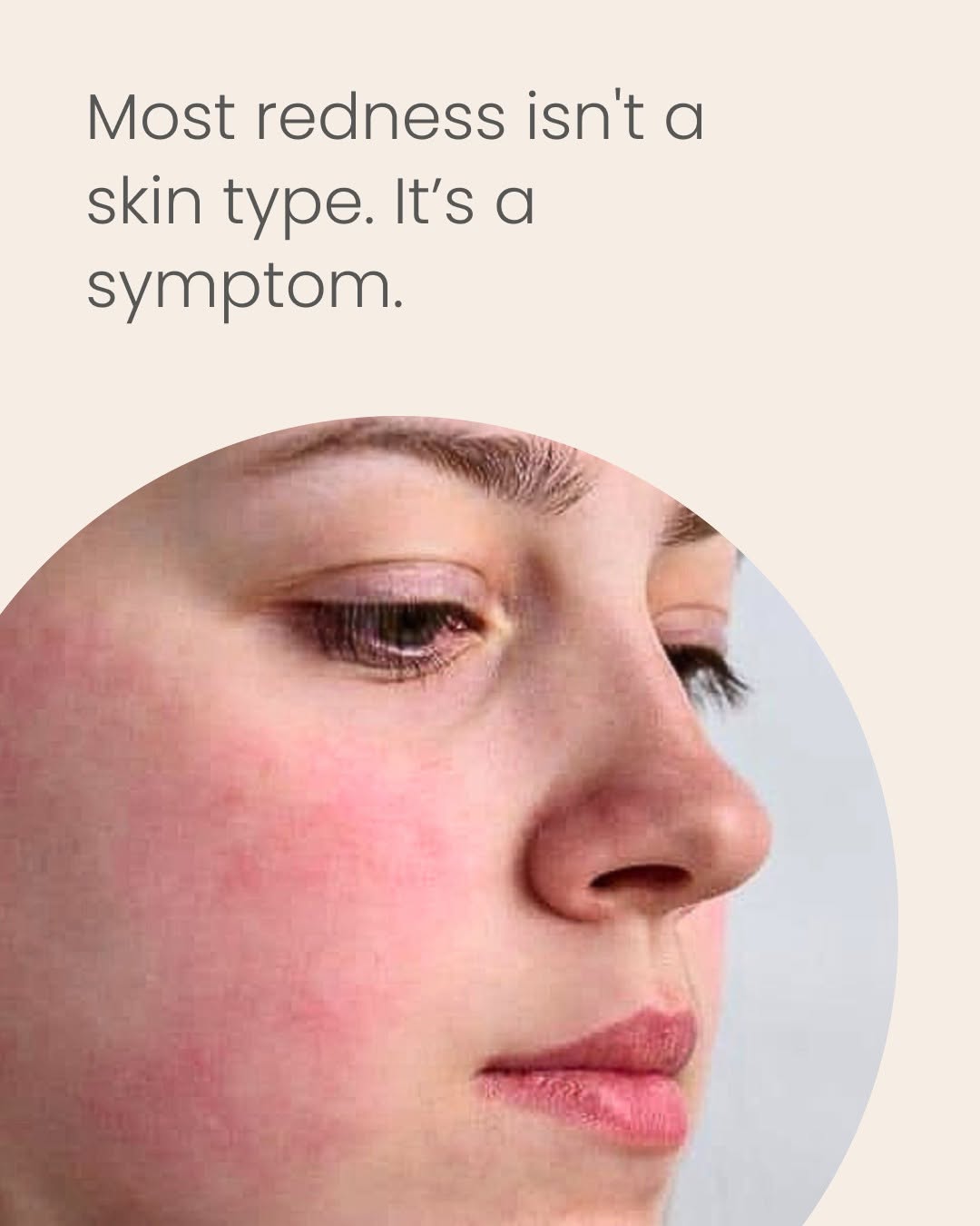 Instagram post by Dr. Cheryl Lee Eberting: Redness that keeps coming back isn't something you just have to live with. It's usually your skin flagging one of four things: a damaged bar…