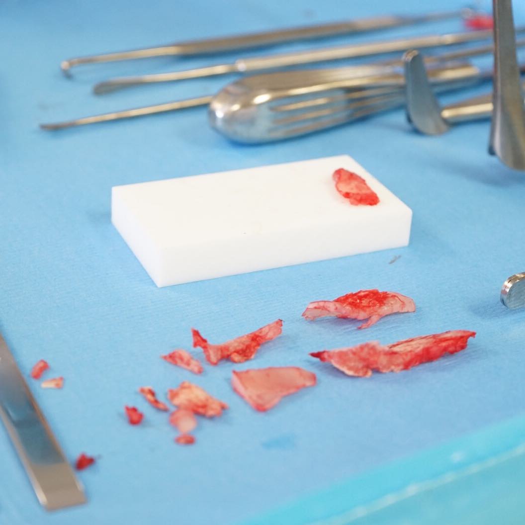Instagram post by Dr. Chester F. Griffiths: #Cartilage ⠀⠀⠀⠀⠀⠀⠀⠀⠀ During a rhinoplasty procedure, the cartilage is removed from the nose. Some is kept out and some is restructured and p…