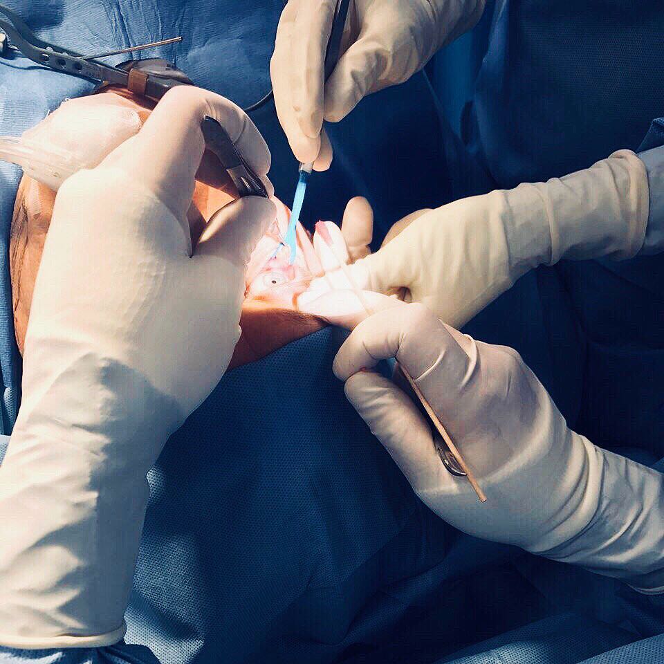 Instagram post by Dr. Chester F. Griffiths: A glimpse into a lower Blepharoplasty procedure - a cosmetic surgery performed to reduce the excess skin that may create “bags” under the ey…