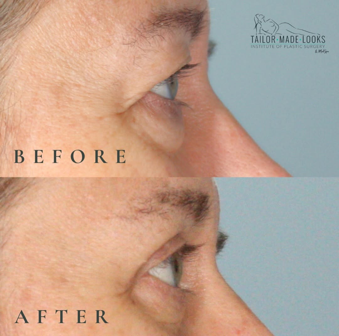 Instagram post by Dr. ChiChi Berhane: one little change can make a huge difference! Check out this beautiful upper blepharoplasty. Think this might be for you? Talk to us. Call t…