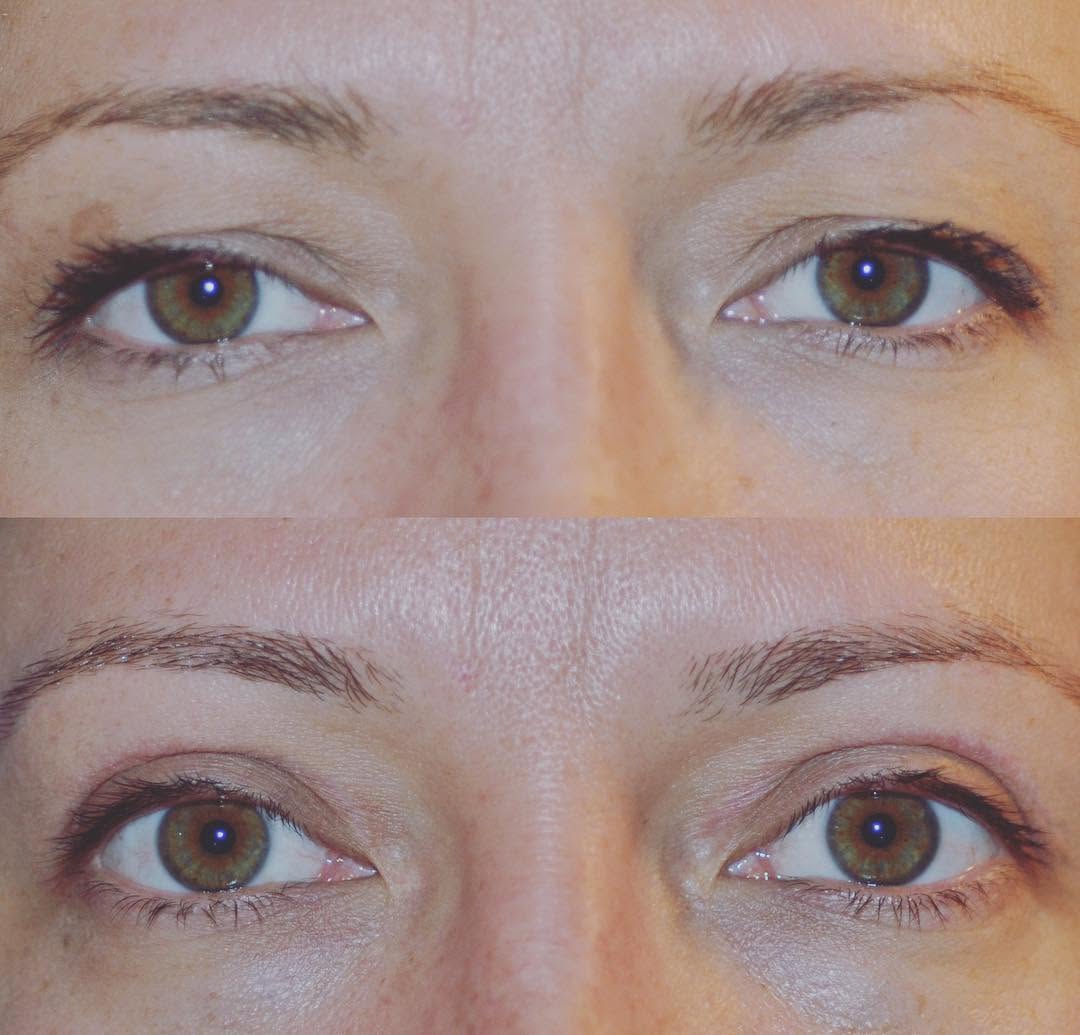 Instagram post by Dr. Chris Thiagarajah: Upper eyelid blepharoplasty or eye lifting is an outpatient procedure that takes 30 min to 1 hour to perform. Recovery is a couple weeks. Pa…
