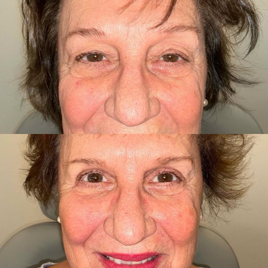 Instagram post by Dr. Chris Thiagarajah: ✨ Before & After: Ptosis Repair + Upper Eyelid Blepharoplasty | Denver, Colorado This transformation shows why ptosis repair and upper eyeli…