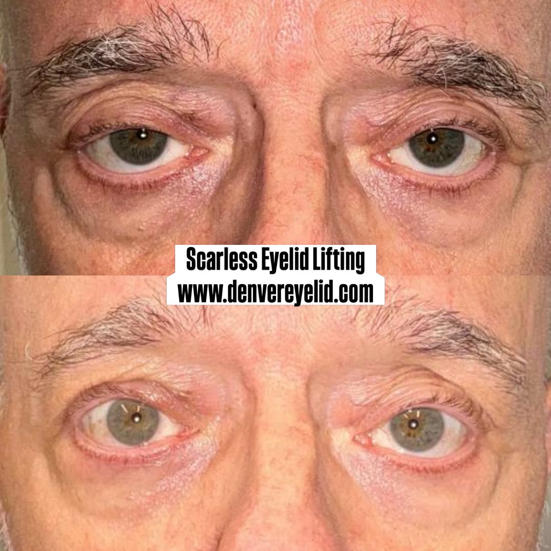 Instagram post by Dr. Chris Thiagarajah: Can you lift a droopy eyelid **without an external scar?** 👁️ In selected patients, yes. An **internal ptosis repair** is sometimes called …