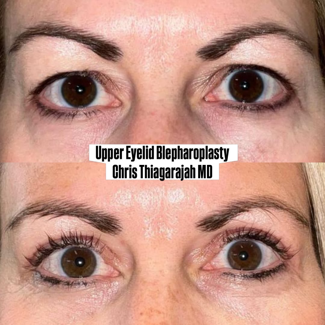 Instagram post by Dr. Chris Thiagarajah: ✨ BEFORE & AFTER: In-Office Upper Eyelid Blepharoplasty in Denver, Colorado Sometimes a small, precise change to the upper eyelids can refre…