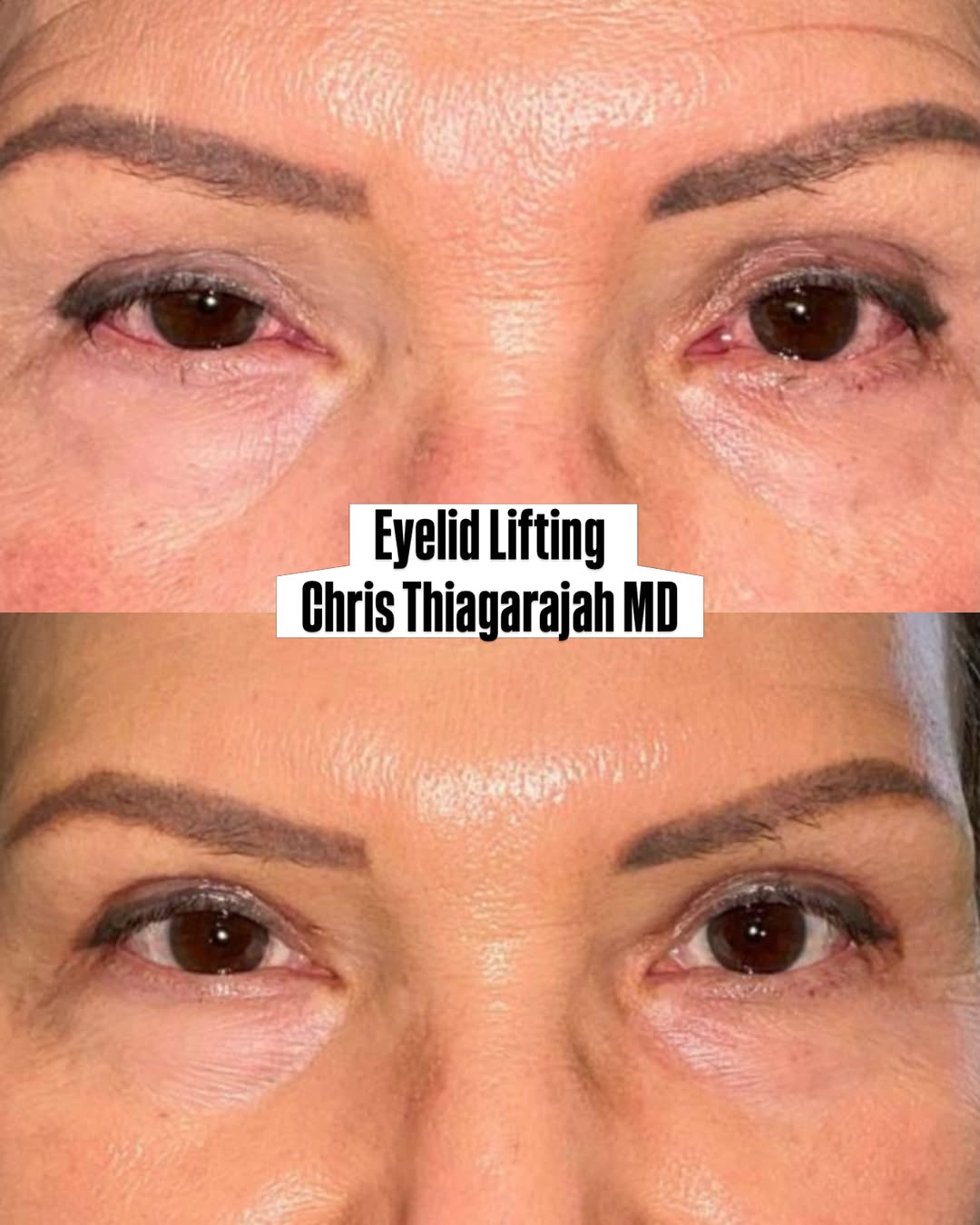 Instagram post by Dr. Chris Thiagarajah: Droopy upper eyelids aren’t always just “tired eyes.” 👁️ This patient had upper eyelid ptosis, and after ptosis repair at Denver Eyelid Spe…