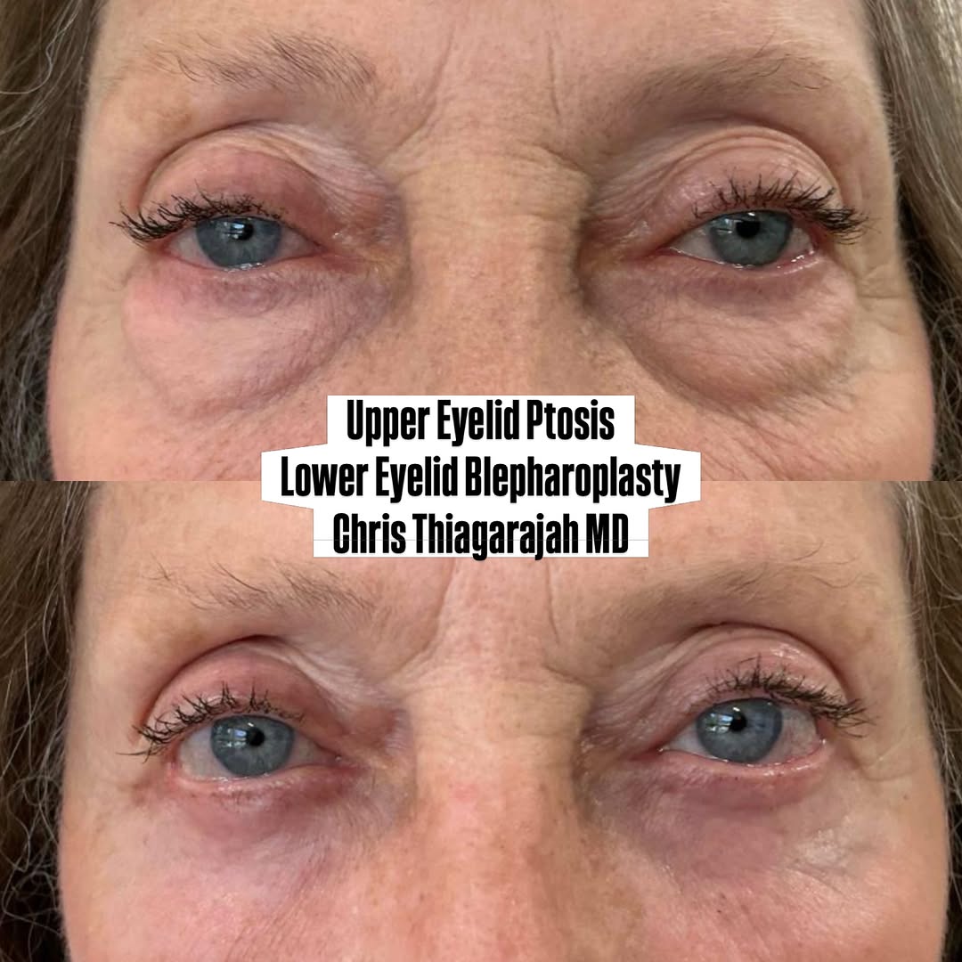 Instagram post by Dr. Chris Thiagarajah: ✨ Before & After: Ptosis Repair + Lower Eyelid Blepharoplasty in Denver, Colorado This transformation combines upper eyelid ptosis repair wi…