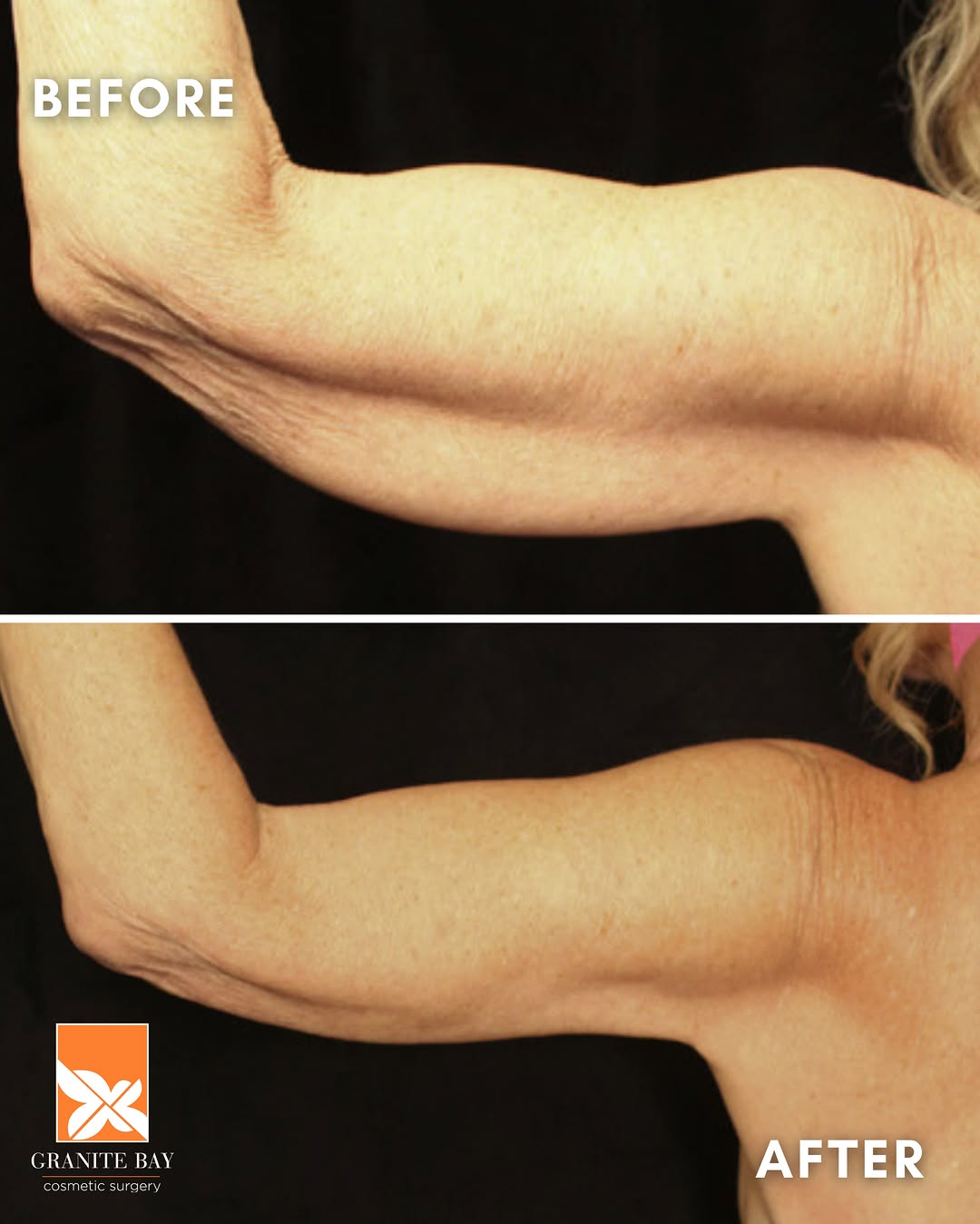 Instagram post by Dr. Christa Clark: Less excess skin. More confidence. A beautifully refined result. ✨ Brachioplasty, also known as an arm lift, is designed to address loose, h…